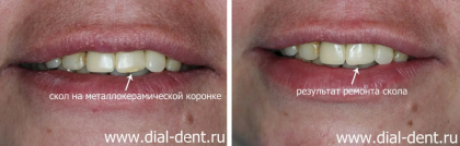 Скол металлокерамической коронки на переднем зубе устранен