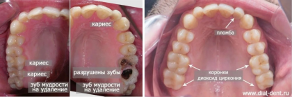 Коронки из диоксида циркония (в том числе на имплантах) для протезирования жевательных зубов - имплантация и лечение зубов в седации