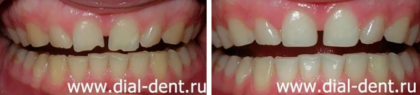 Отбеливание зубов лазером и реставрация передних зубов