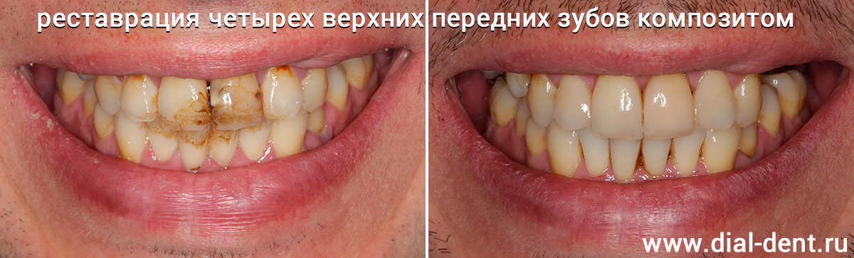 Реставрация зубов помогает росту карьеры