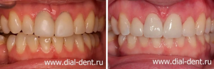 Новые коронки и виниры для реставрации передних зубов
