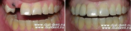 Имплантация зубов в переднем отделе верхней челюсти