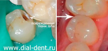 Кариес зубов - ранняя диагностика и лечение