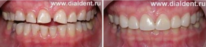 Реставрация верхних передних зубов винирами, разные клинические случаи