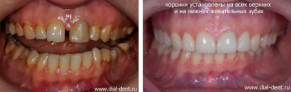 Протезирование зубов керамикой для восстановления функции и эстетики
