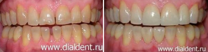 Закрытие щелей между зубами с помощью виниров