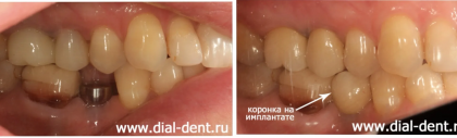 Протезирование на имплантах – прикручиваемая коронка