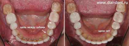 Закрытие щели между зубами капами 3D Smile