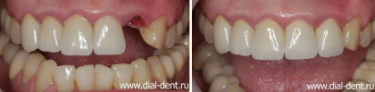 Перелом переднего зуба и одномоментная имплантация