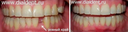 Комплексное лечение в «Диал-Дент»: выравнивание, имплантация и протезирование зубов