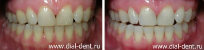 Лазерное отбеливание зубов для улучшения эстетики улыбки