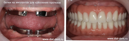 Полные протезы на имплантах – когда свои зубы уже не сохранить