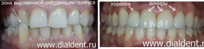 Первичная адентия — комплексное решение