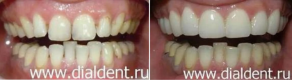 Керамические виниры — решение при комплексе проблем