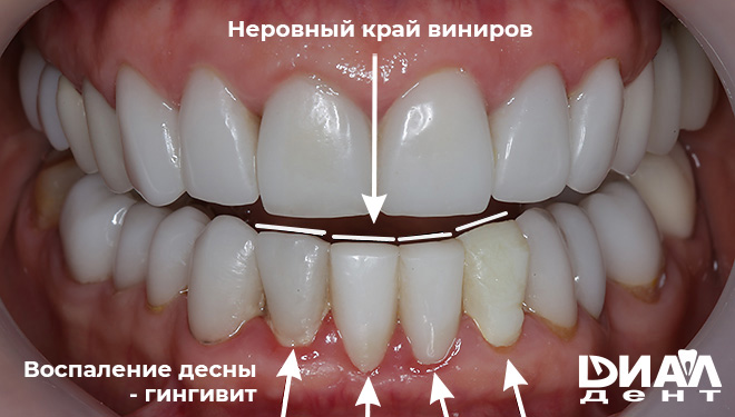 Керамические виниры от стоматологов Черногории
