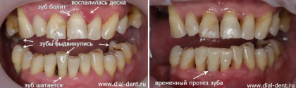 Выпал передний зуб при пародонтите - экстренная помощь