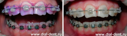 Профессиональная чистка зубов с брекетами