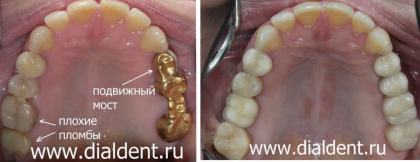Протезирование зубов — комплексный подход