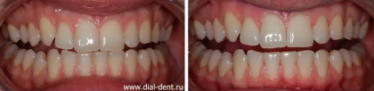 Профессиональная гигиена полости рта у беременных