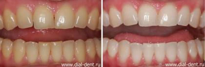 ZOOM 4 отбеливание зубов для сияющей улыбки