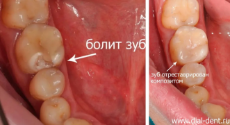 Симптоматический пульпит – лечение зуба с микроскопом