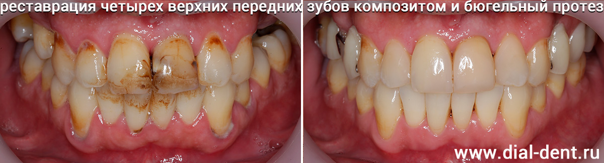 Гигиена полости рта, лечение кариеса, художественная реставрация передних зубов и бюгельное протезирование боковых зубов