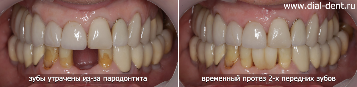 Временное протезирование фронтальных зубов