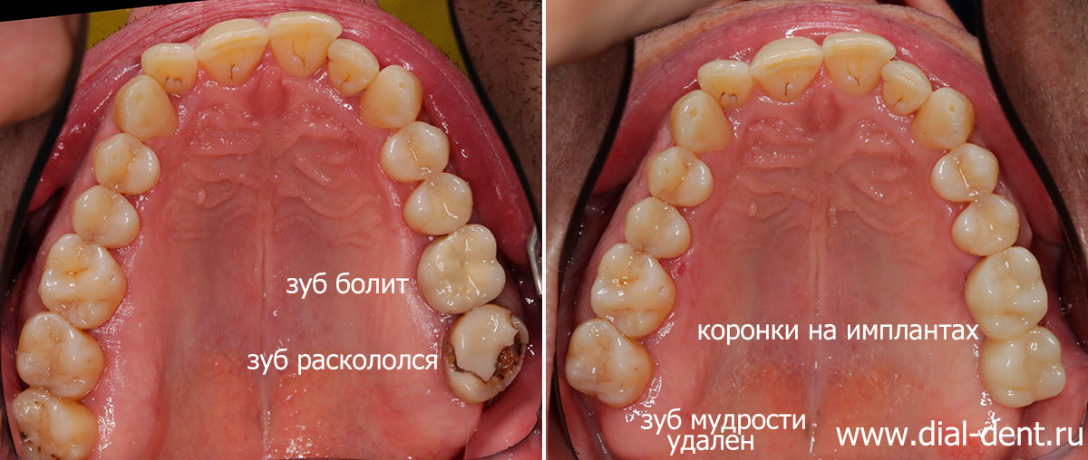 Удаление разрушенных зубов и замена их зубными имплантами с керамическими коронками