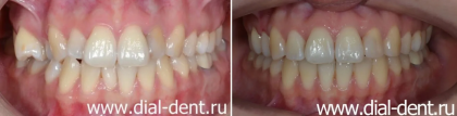 Ровные зубы с помощью брекет-системы Insignia