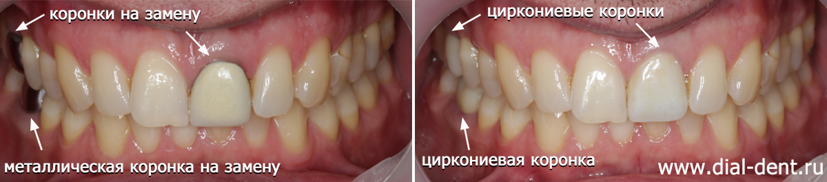 Замена устаревших металлокерамической и металлических коронок на современные керамические коронки