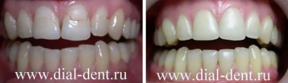 Художественная реставрация передних зубов