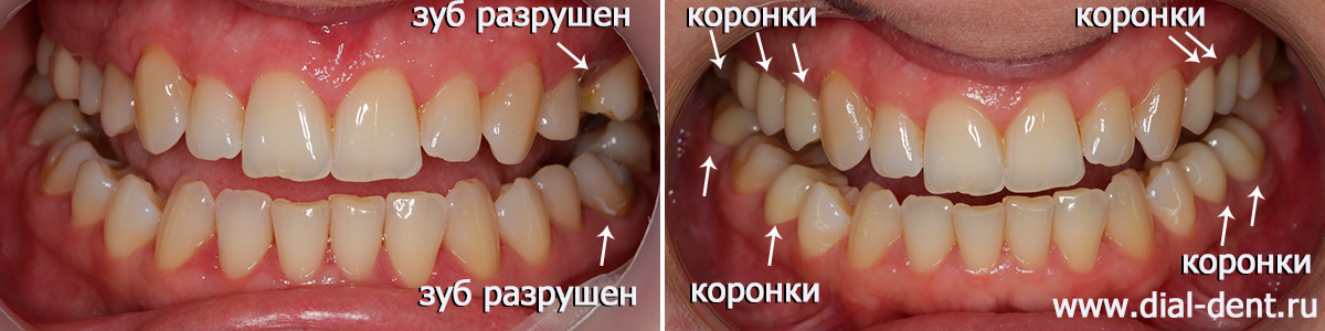 Спасение двух зубов и физиологичное протезирование 9 зубов коронками из оксида циркония