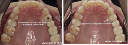 Раскол зуба и одномоментная имплантация