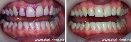 Профессиональная чистка налета курильщика и коррекция техники чистки