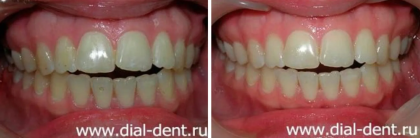 Лазерное отбеливание зубов – устойчивые результаты 