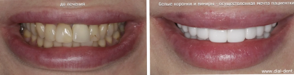 Белоснежные зубы – реализация мечты при помощи белых керамических коронок и виниров