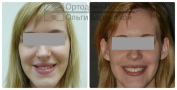 Операция по исправлению прикуса и лечение брекетами