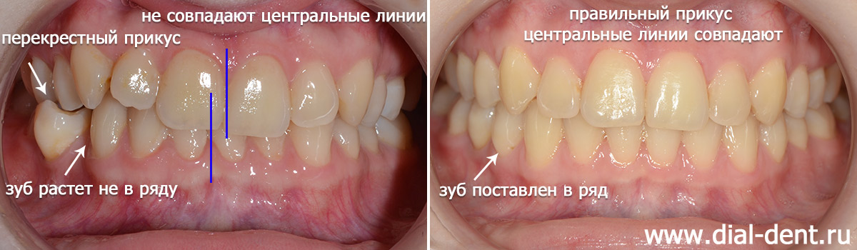 Исправление прикуса брекетами Damon