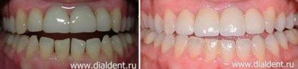 Частичные брекеты при эстетической реставрации зубов