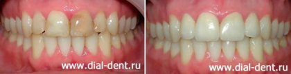 Реставрация передних зубов