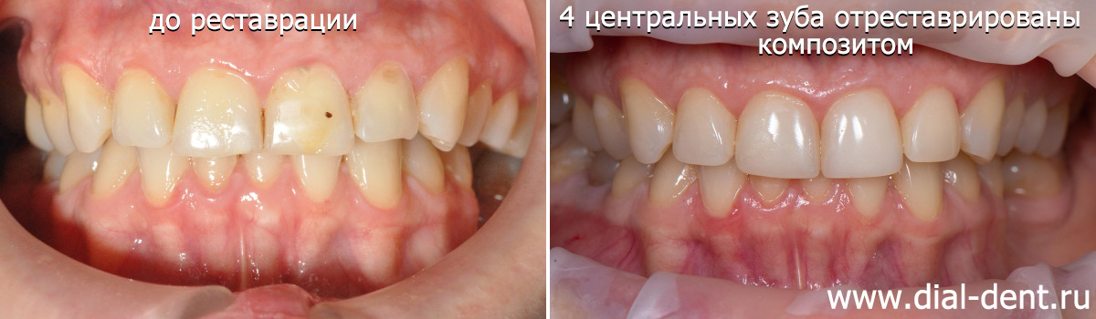 Эстетическая реставрация передних зубов за 3 часа