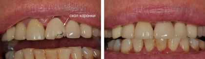 Скол переднего зуба с металлокерамической коронкой