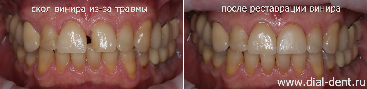 Скол винира из-за спортивной травмы