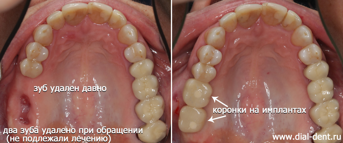 Замещение концевых дефектов имплантами