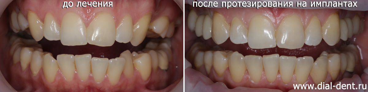 Удаление молочного зуба у взрослого и восстановление отсутствующих с рождения зубов коронками на имплантах
